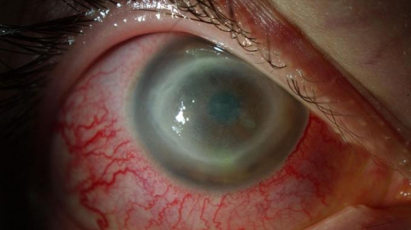 عفونت چشم و لنز