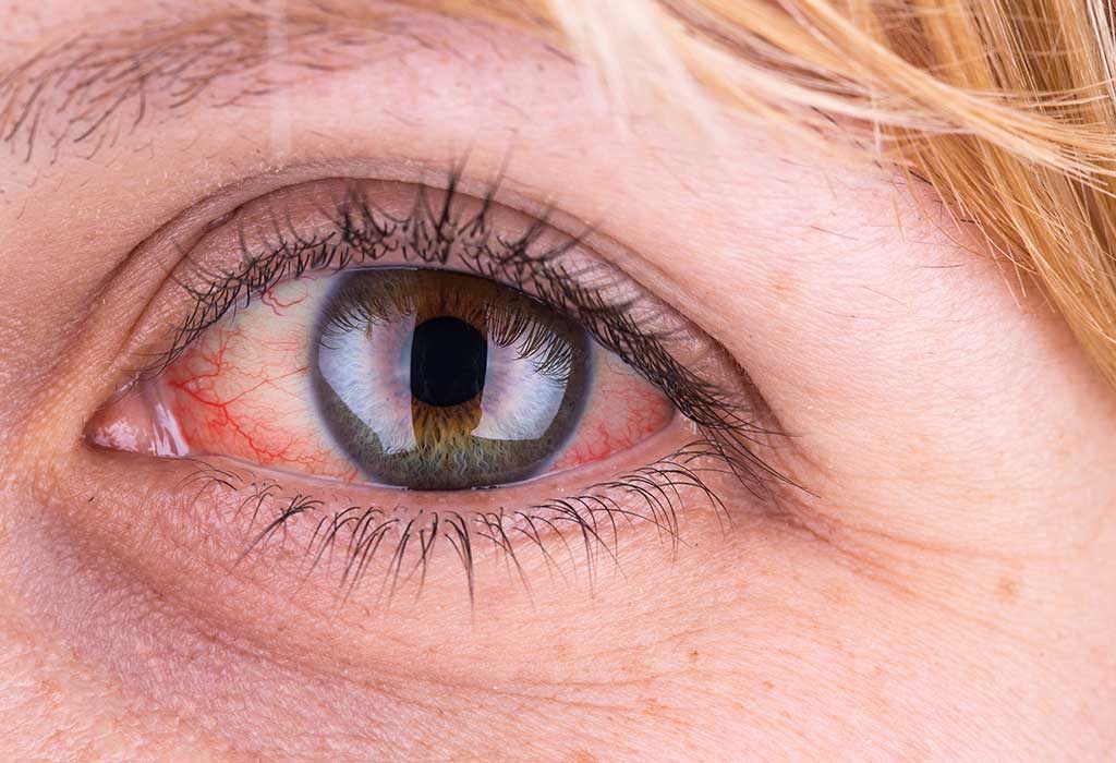قرمزی چشم هنگام استفاده از لنز