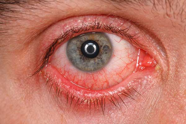 حساسیت چشم به لنز
