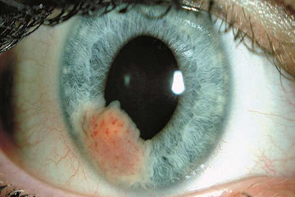 شایع ترین تومورهای داخل چشمی