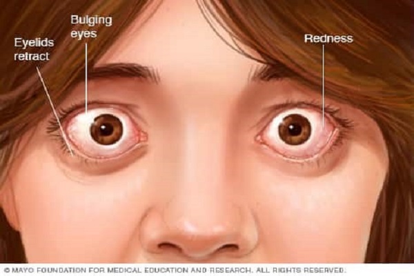 بیماری گریوز چشمی یا بیرون زدگی چشم چیست؟