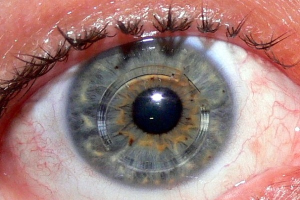 رینگ گذاری داخل چشم چیست؟
