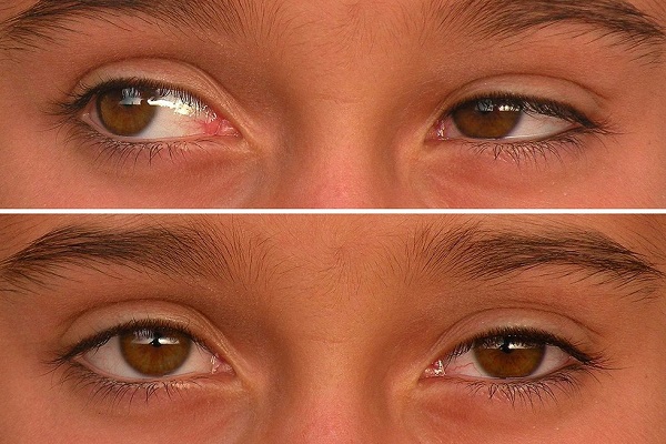 نیستاگموس یا دودوئک چشم چیست؟